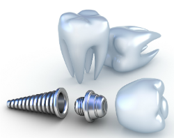 dental implants