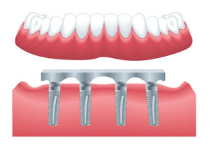 implant denture