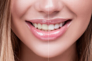 teeth-whitening_smile