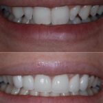 Before and after photos of teeth of smiling patient