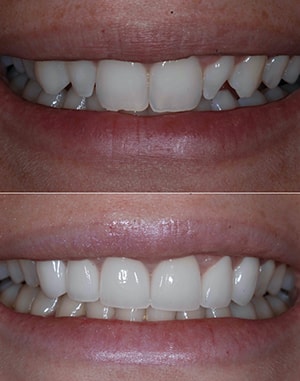 Before and after photos of teeth of smiling patient